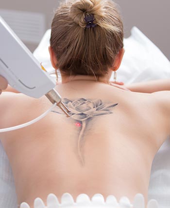 Laser Tattoo Removal in West Covina, CA
