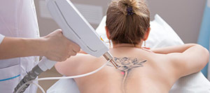 Laser Tattoo Removal Specialist Near Me in West Covina, CA