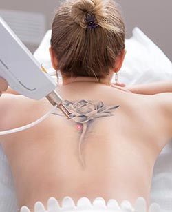 Laser Tattoo Removal in West Covina, CA