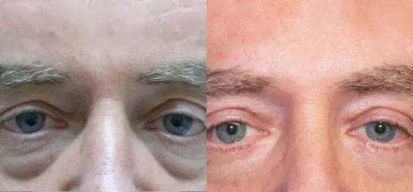 Blepharoplasty Case #2085