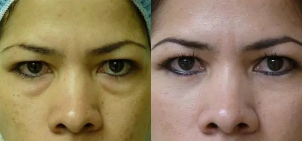 Blepharoplasty Case #2075

