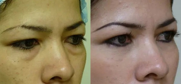 Blepharoplasty Case #2075