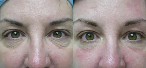 Blepharoplasty Case #2093
