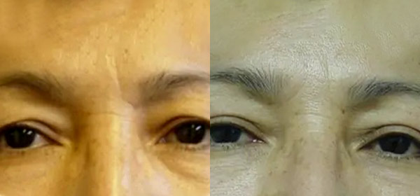 Blepharoplasty Case #2096