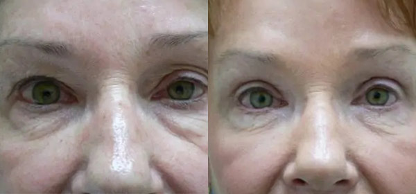 Blepharoplasty Case #2088