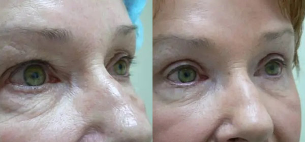 Blepharoplasty Case #2088