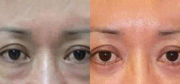 Blepharoplasty Case #2099
