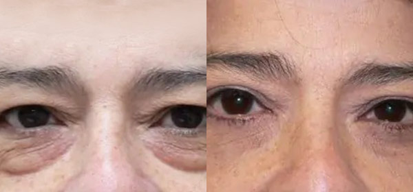 Blepharoplasty Case #2012