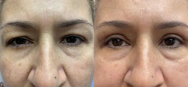 Blepharoplasty Case #2442