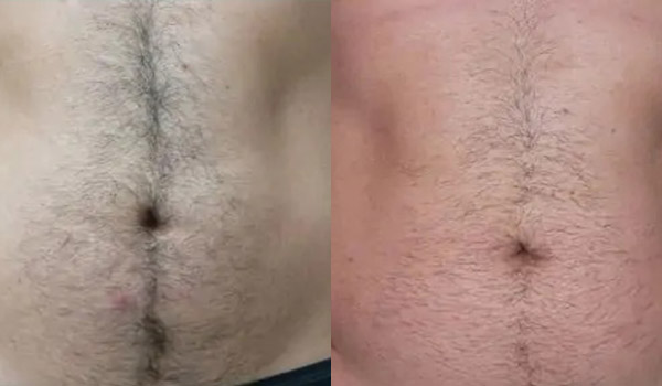 Liposuction Case #1945 Liposuction Case #1945