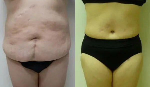 Liposuction Case #2004 Liposuction Case #2004