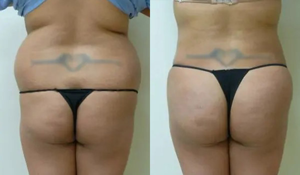 Liposuction Case #1924 Liposuction Case #1924