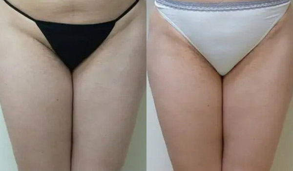 Liposuction Case #1932 Liposuction Case #1932