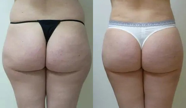 Liposuction Case #1932 Liposuction Case #1932