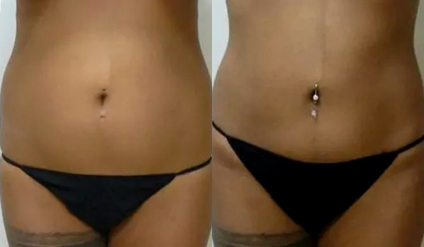 Liposuction Case #1927 Liposuction Case #1927