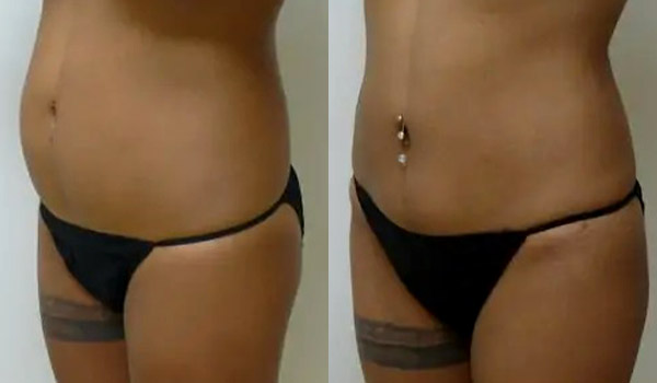 Liposuction Case #1927 Liposuction Case #1927