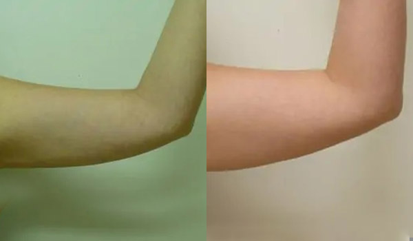 Liposuction Case #1940 Liposuction Case #1940