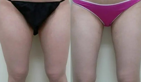 Liposuction Case #1937 Liposuction Case #1937