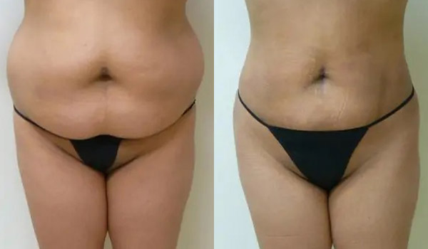 Liposuction Case #1924 Liposuction Case #1924