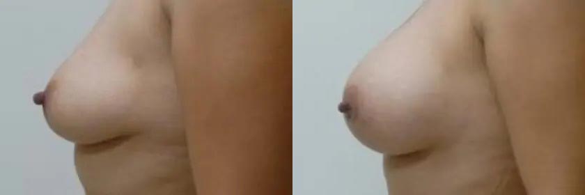 Breast Augmentation Case #2105