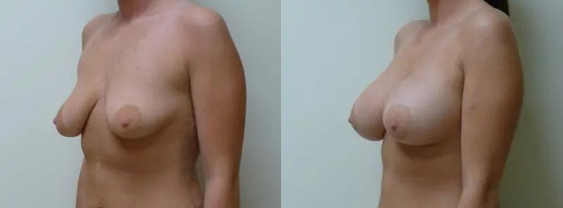 Breast Augmentation Case #2125