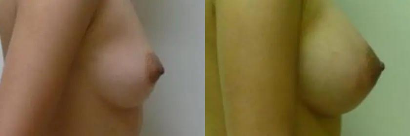 Breast Augmentation Case #2155