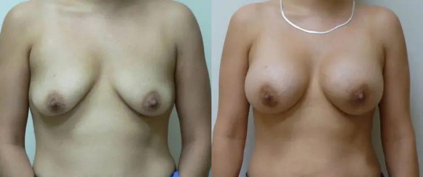 Breast Augmentation Case #2130