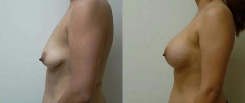Breast Augmentation Case #2130