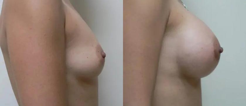Breast Augmentation Case #2160