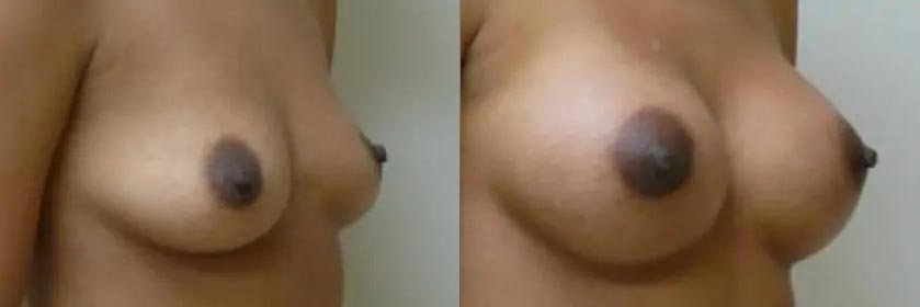 Breast Augmentation Case #2135