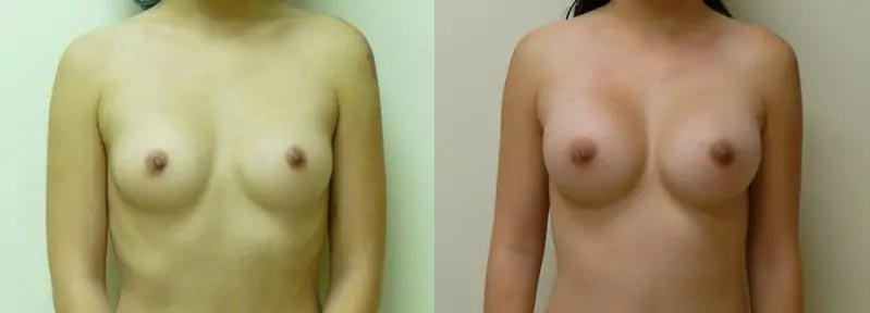 Breast Augmentation Case #2165