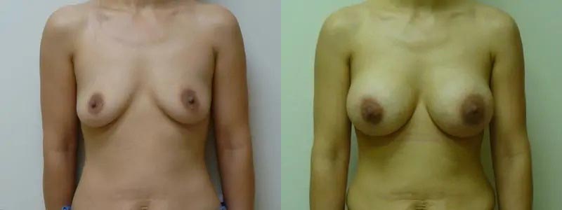 Breast Augmentation Case #2140