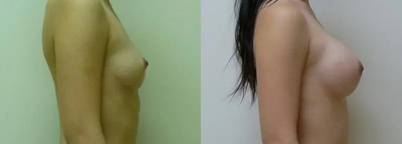 Breast Augmentation Case #2165