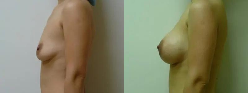 Breast Augmentation Case #2140