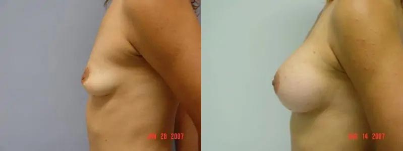 Breast Augmentation Case #2175