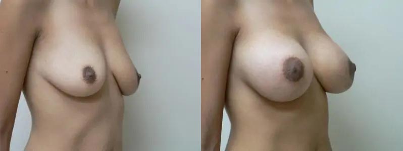 Breast Augmentation Case #2145