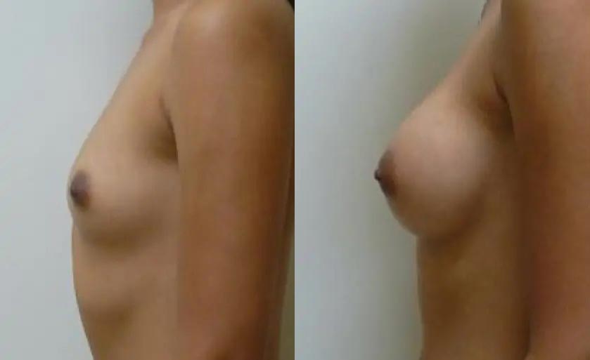 Breast Augmentation Case #2180