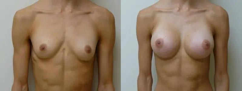 Breast Augmentation Case #2150