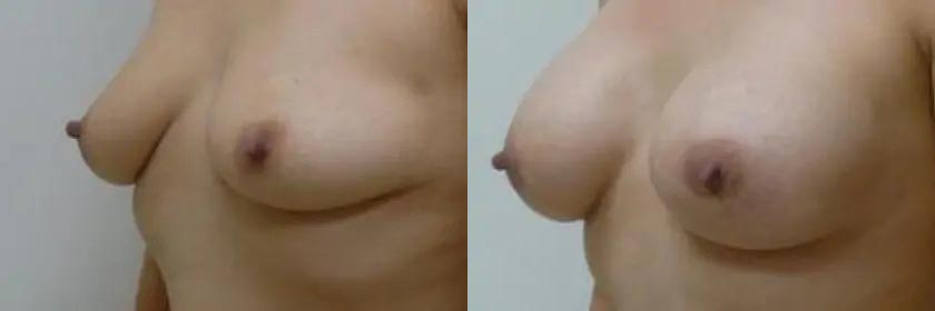 Breast Augmentation Case #2105