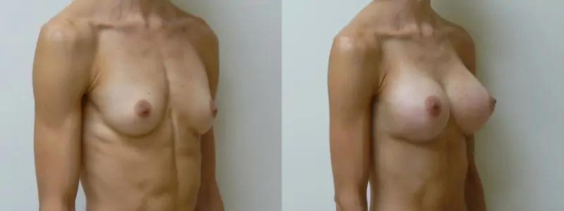 Breast Augmentation Case #2150