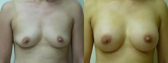 Breast Augmentation Case #2190