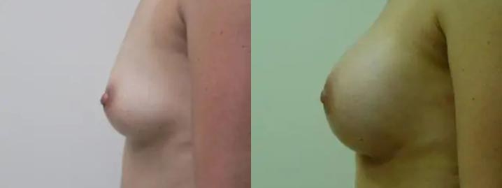 Breast Augmentation Case #2190