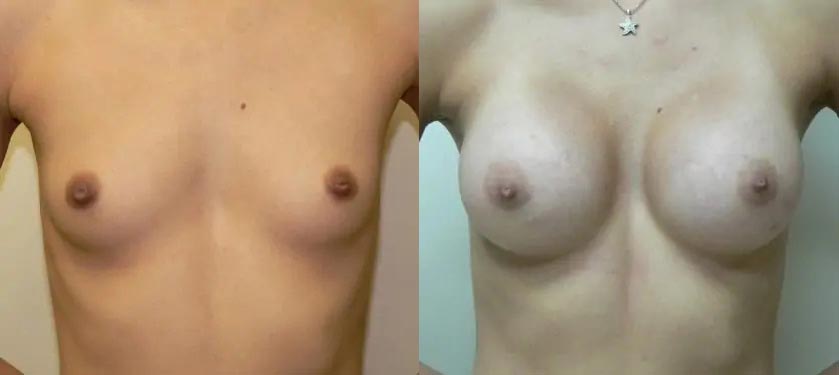 Breast Augmentation Case #2195