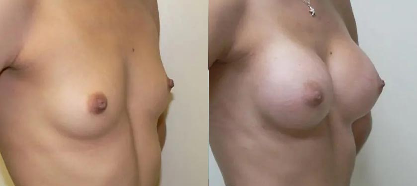Breast Augmentation Case #2195