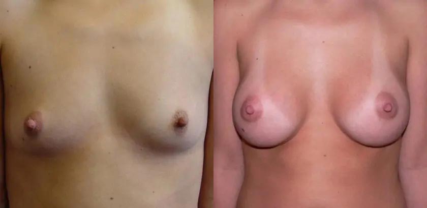 Breast Augmentation Case #2200