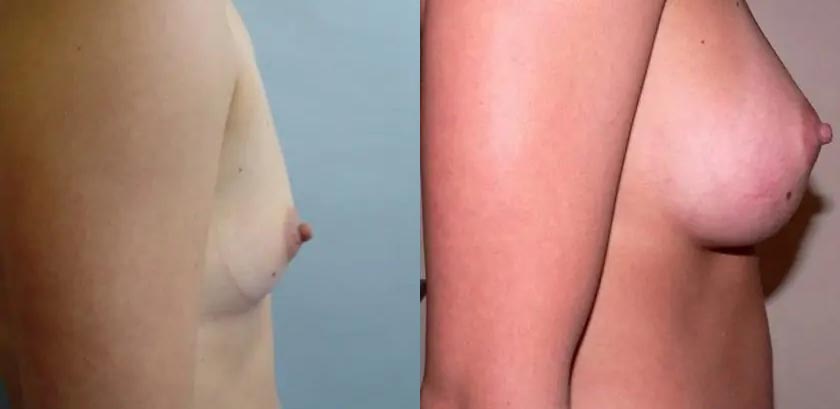 Breast Augmentation Case #2200