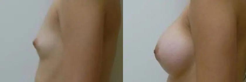 Breast Augmentation Case #2205