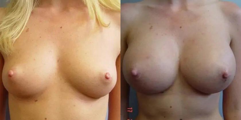 Breast Augmentation Case #2110