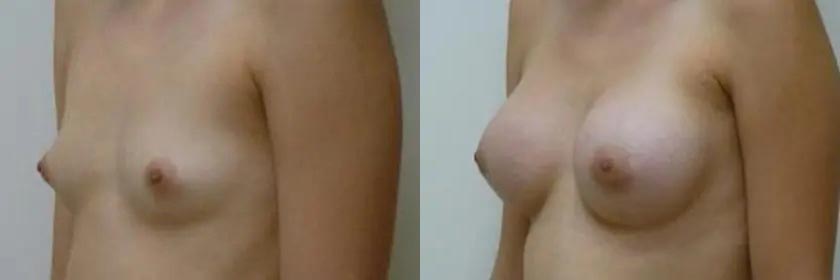 Breast Augmentation Case #2205