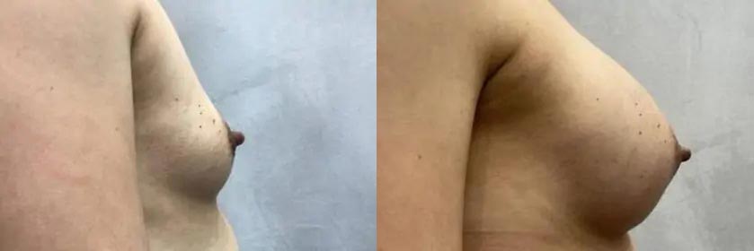 Breast Augmentation Case #2332